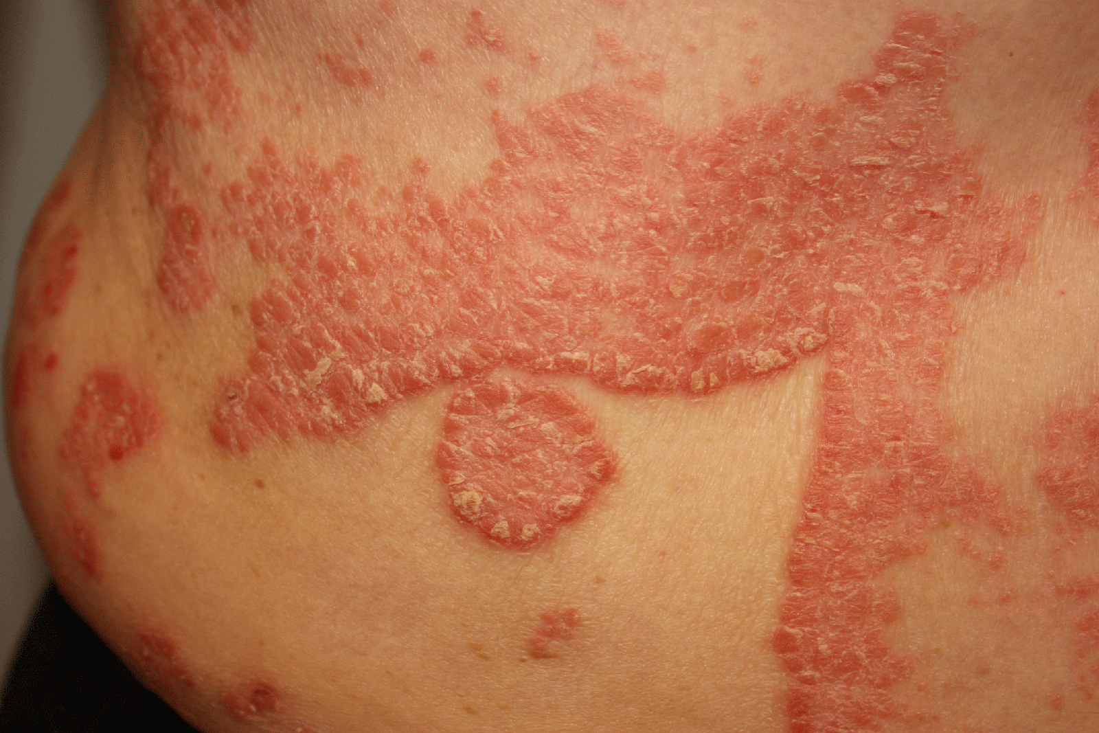 Home Remedies For Genital Psoriasis Home Remedies For Genital Psoriasis