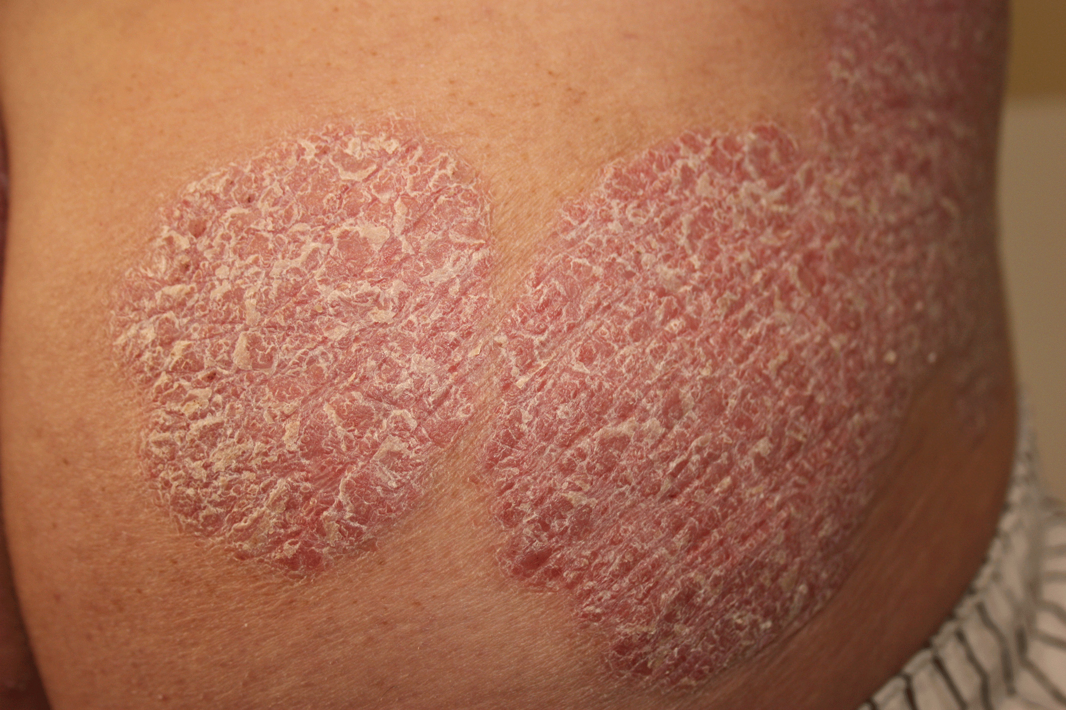 PSORTWhat is Psoriasis? PSORT